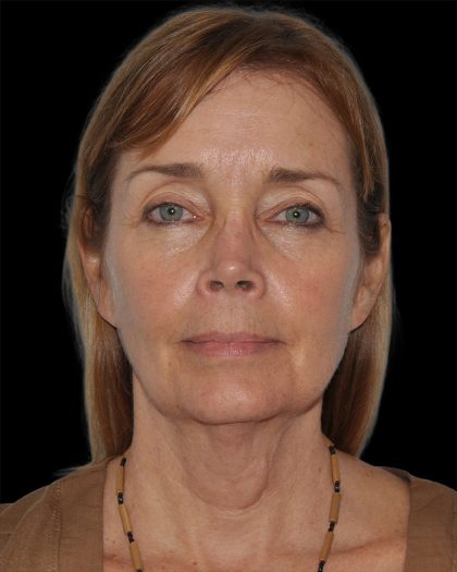 Facelift Before & After Patient #8959