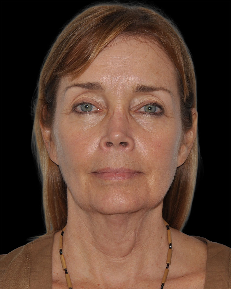Facelift Before & After Patient #8959