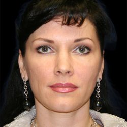 Facelift Before & After Patient #8960