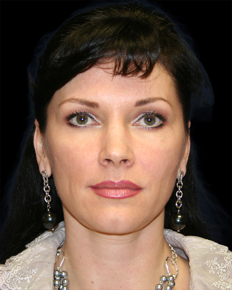 Facelift Before & After Patient #8960