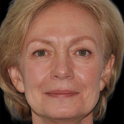 Facelift Before & After Patient #9131