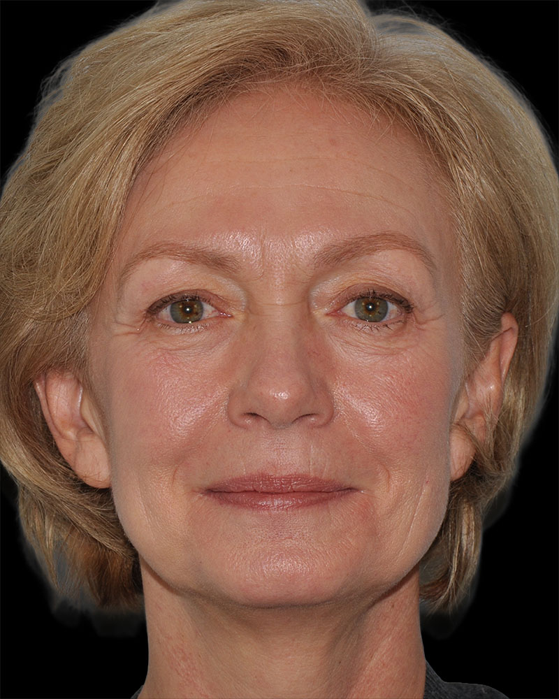 Facelift Before & After Patient #9131