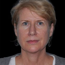 Facelift Before & After Patient #9135