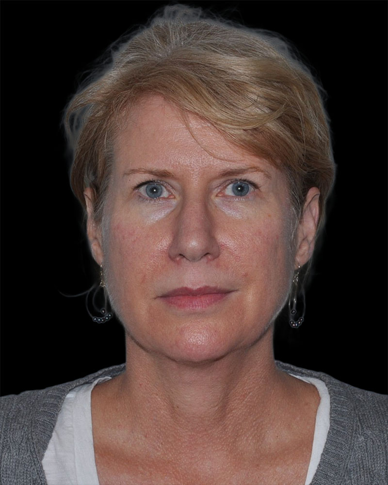 Facelift Before & After Patient #9135