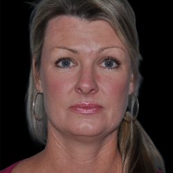 Facelift Before & After Patient #9138