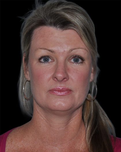 Facelift Before & After Patient #9138