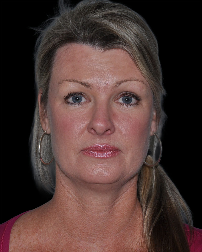 Facelift Before & After Patient #9138