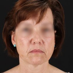 Facelift Before & After Patient #9173