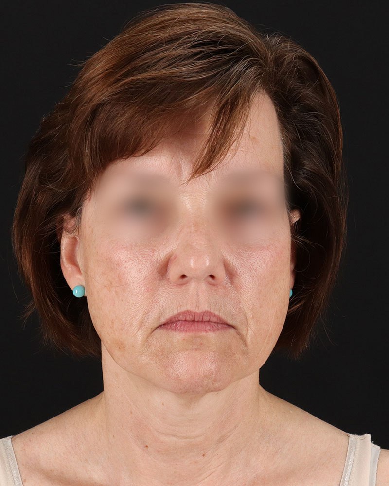 Facelift Before & After Patient #9173