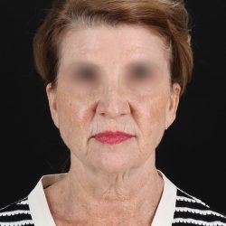 Facelift Before & After Patient #9140