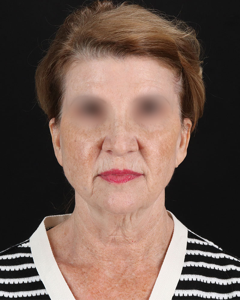 Facelift Before & After Patient #9140