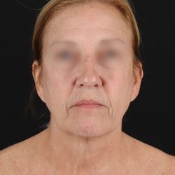 Facelift Before & After Patient #8957