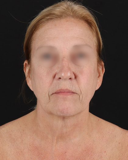 Facelift Before & After Patient #8957