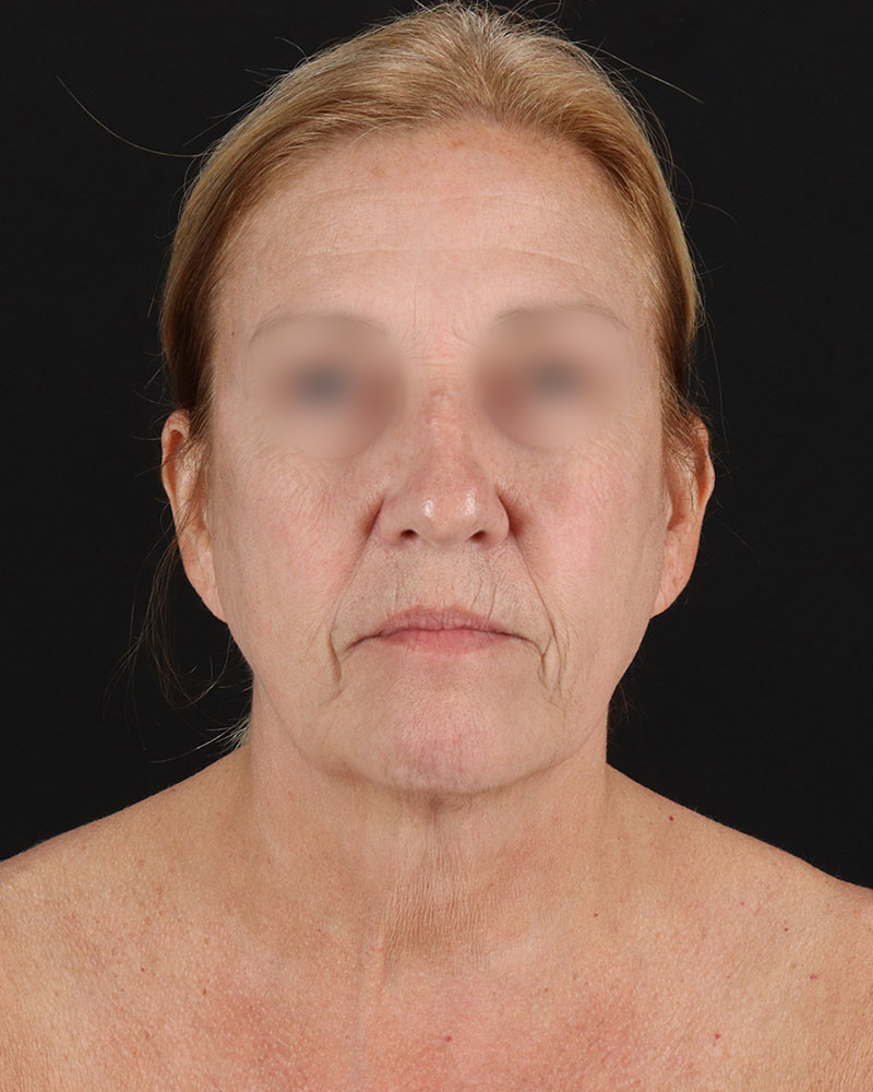 Facelift Before & After Patient #8957