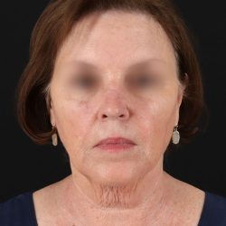 Facelift Before & After Patient #8954