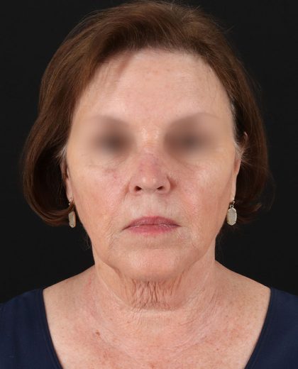 Facelift Before & After Patient #8954