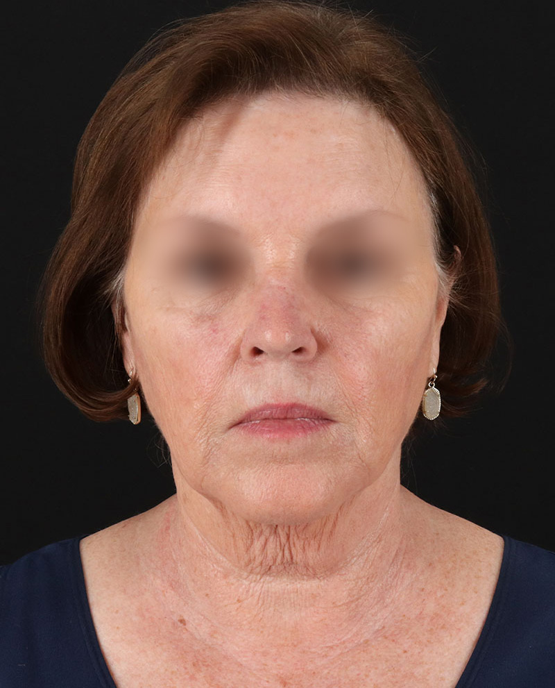 Facelift Before & After Patient #8954