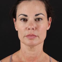 Facelift Before & After Patient #8942