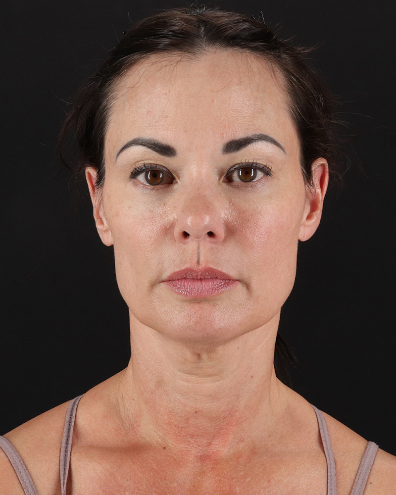 Facelift Before & After Patient #8942