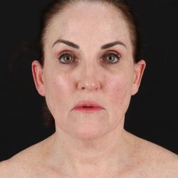 Facelift Before & After Patient #8943