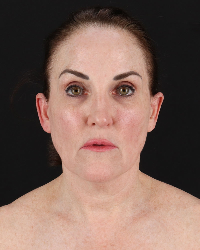 Facelift Before & After Patient #8943