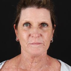 Facelift Before & After Patient #8944