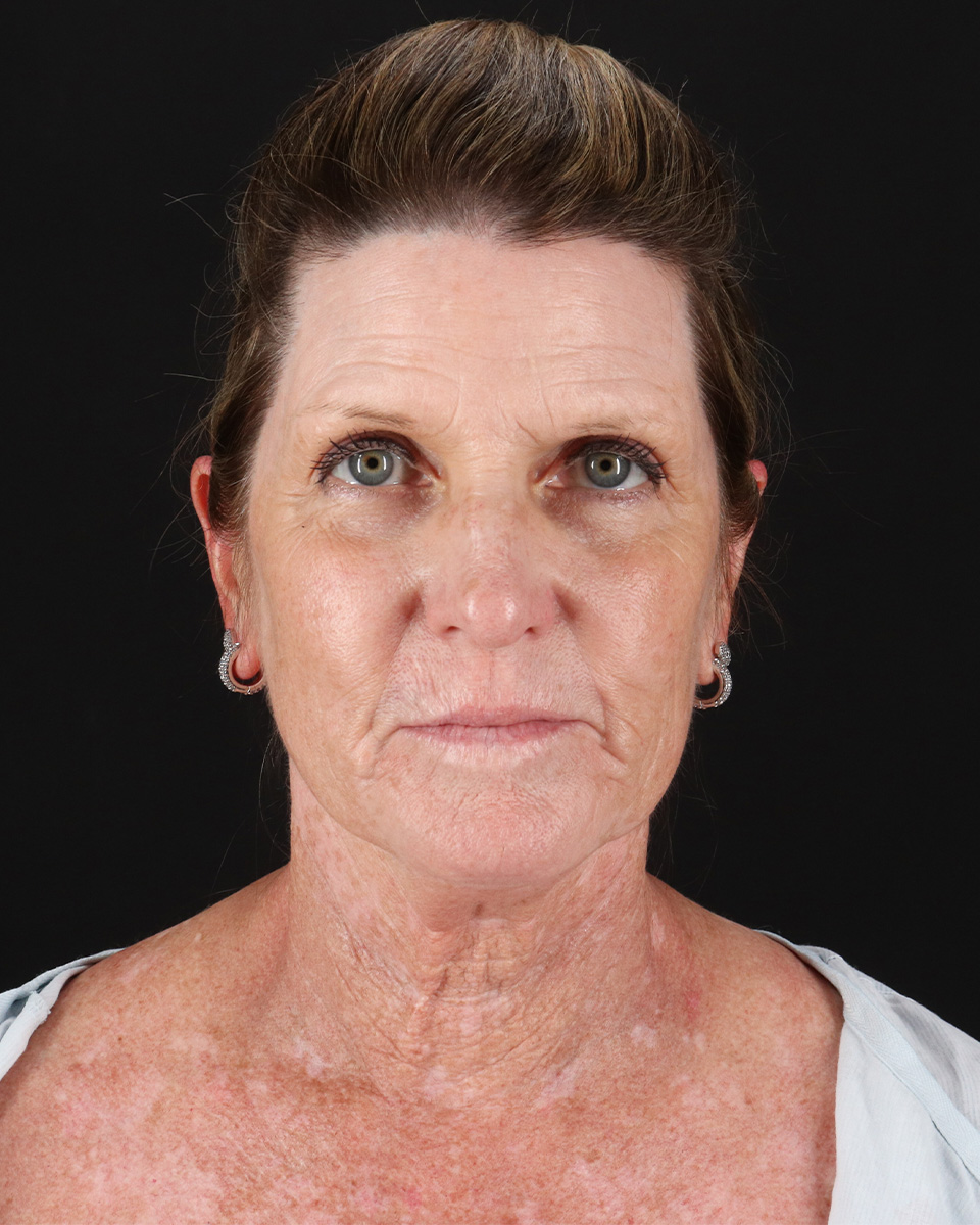Facelift Before & After Patient #8944