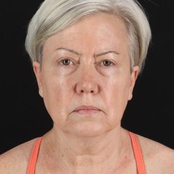 Facelift Before & After Patient #8946