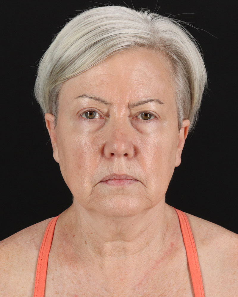 Facelift Before & After Patient #8946