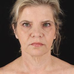 Facelift Before & After Patient #8947