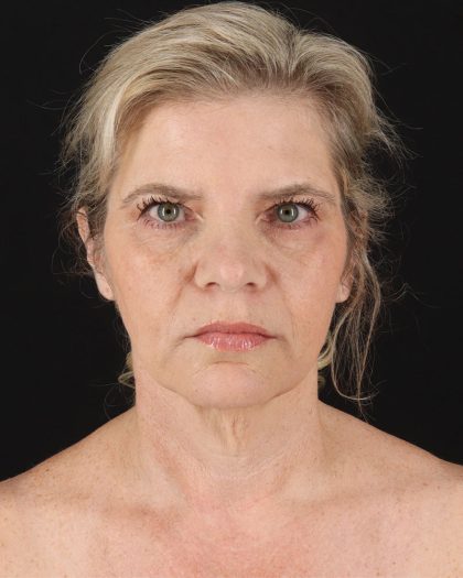 Facelift Before & After Patient #8947