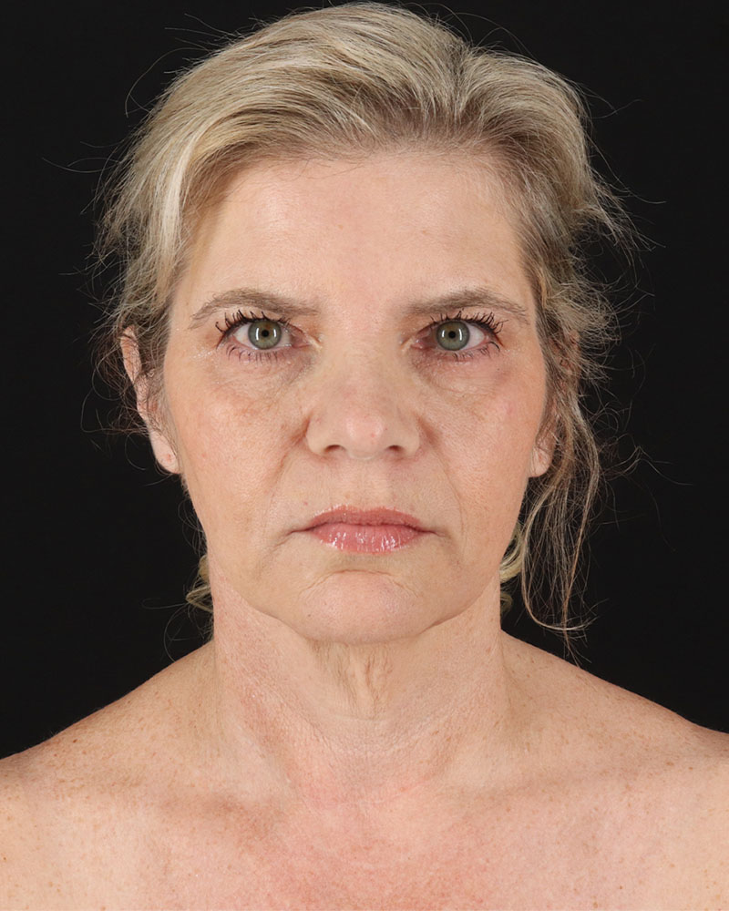 Facelift Before & After Patient #8947