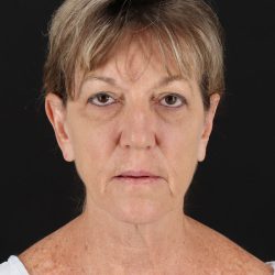 Facelift Before & After Patient #8948