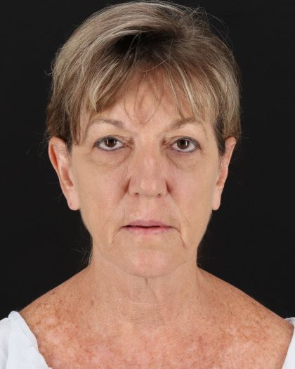 Facelift Before & After Patient #8948