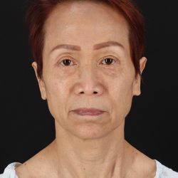 Facelift Before & After Patient #8950