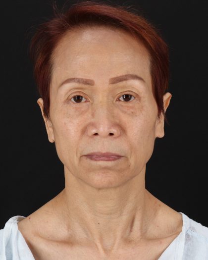 Facelift Before & After Patient #8950
