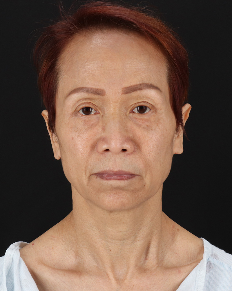 Facelift Before & After Patient #8950