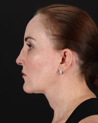 Facelift Before & After Patient #8943