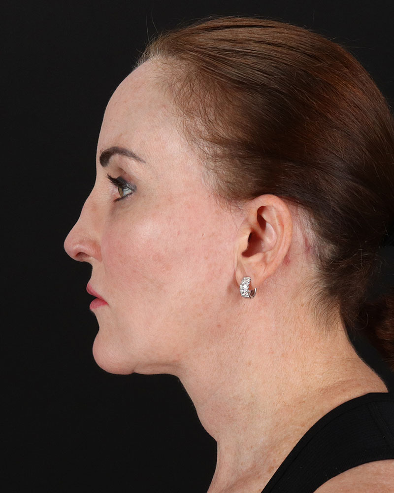 Facelift Before & After Patient #8943