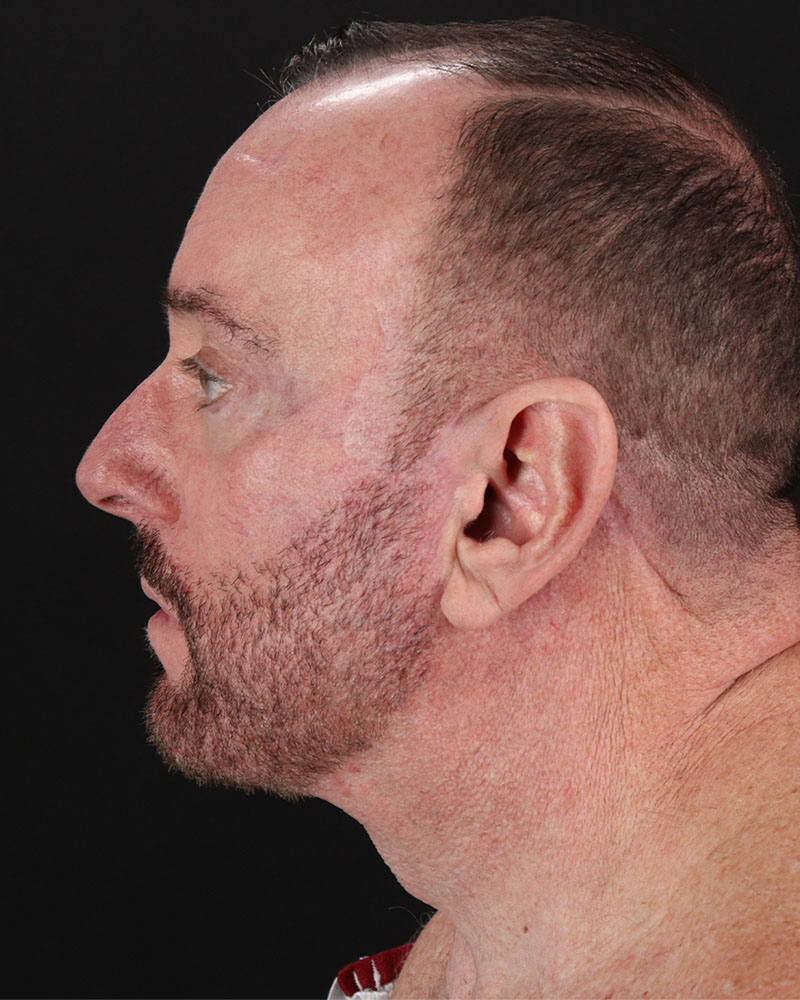 Facelift Before & After Patient #8955
