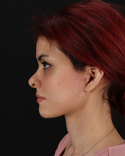 Mini Facelift Before & After Patient #8956