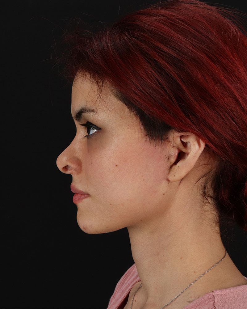 Mini Facelift Before & After Patient #8956