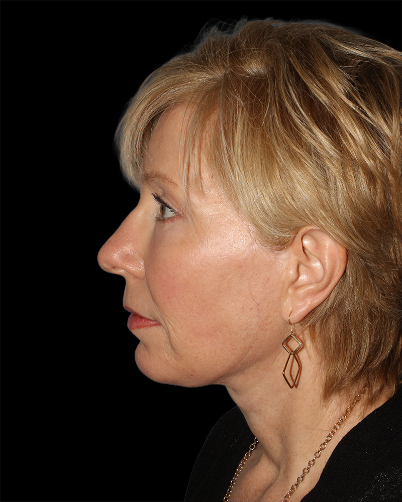 Facelift Before & After Patient #8958