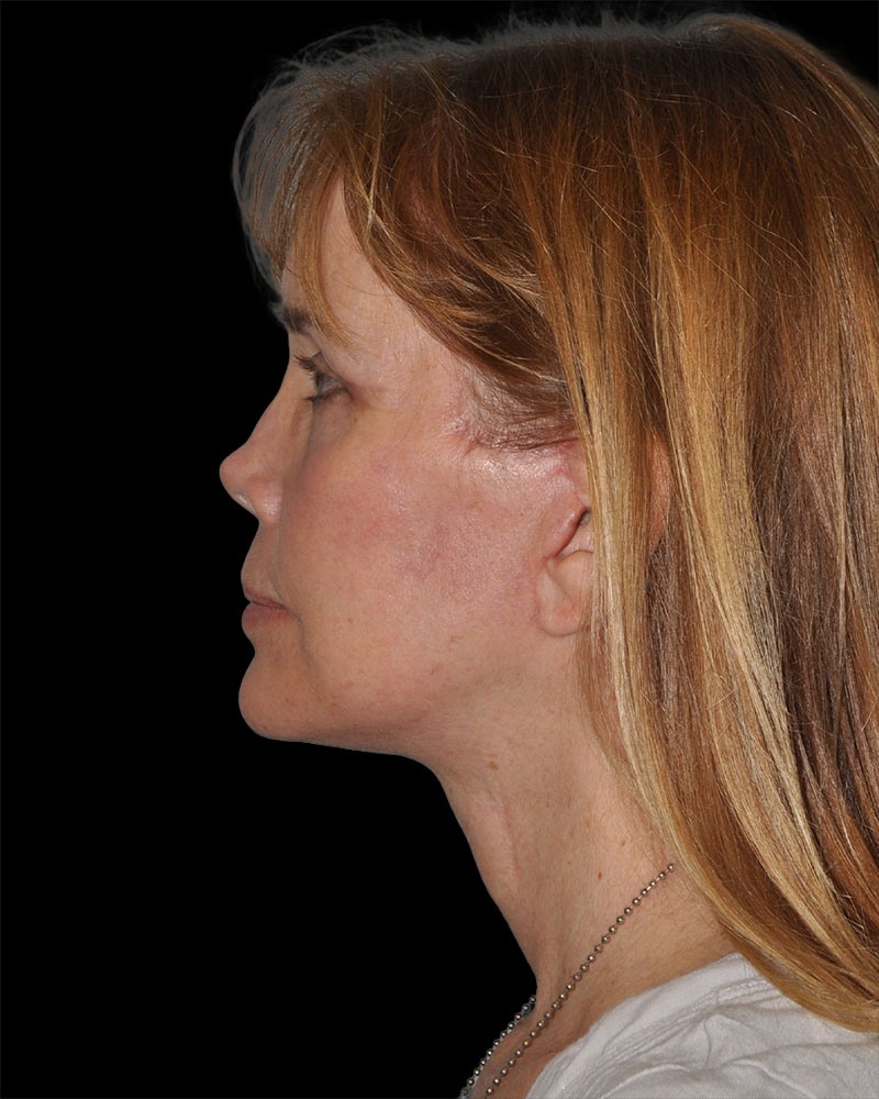 Facelift Before & After Patient #8959