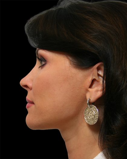 Facelift Before & After Patient #8960
