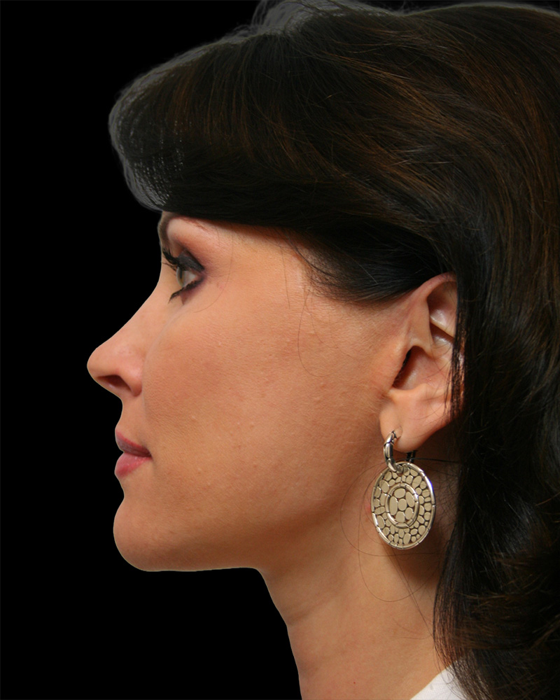 Facelift Before & After Patient #8960
