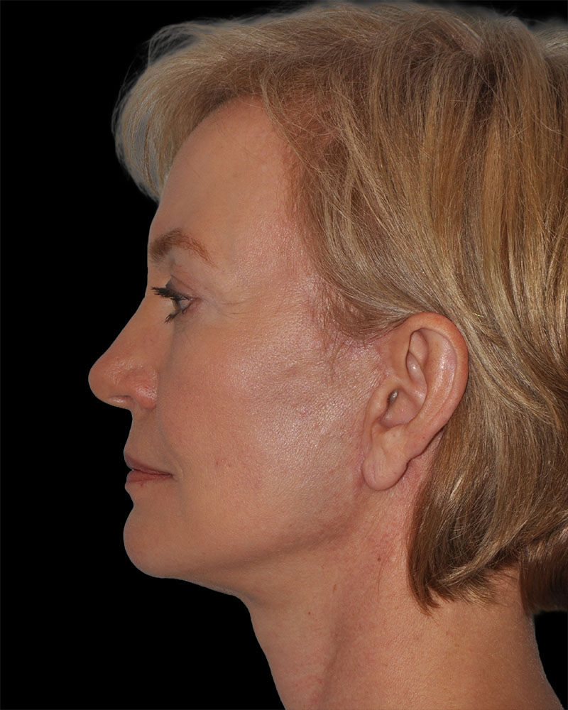 Facelift Before & After Patient #9131