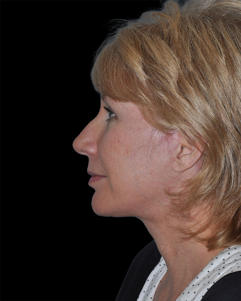 Facelift Before & After Patient #9135