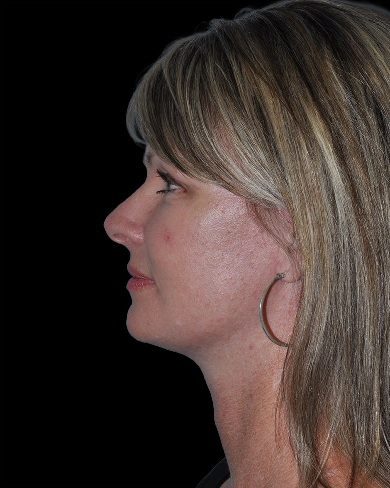 Facelift Before & After Patient #9138