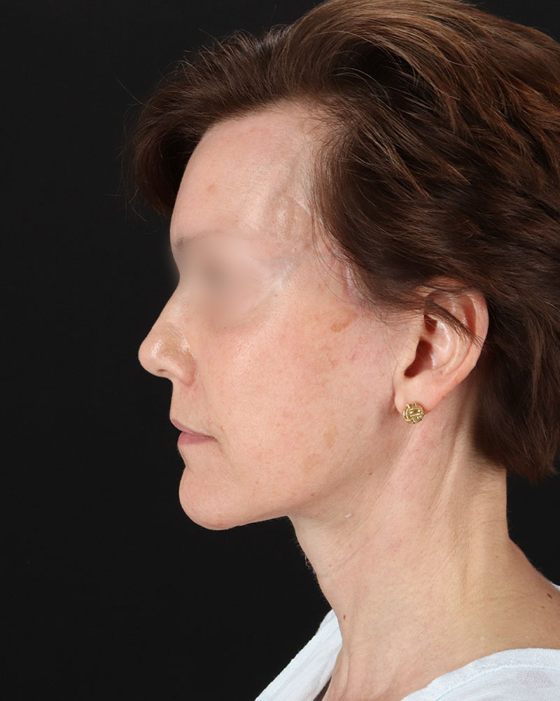 Facelift Before & After Patient #9173